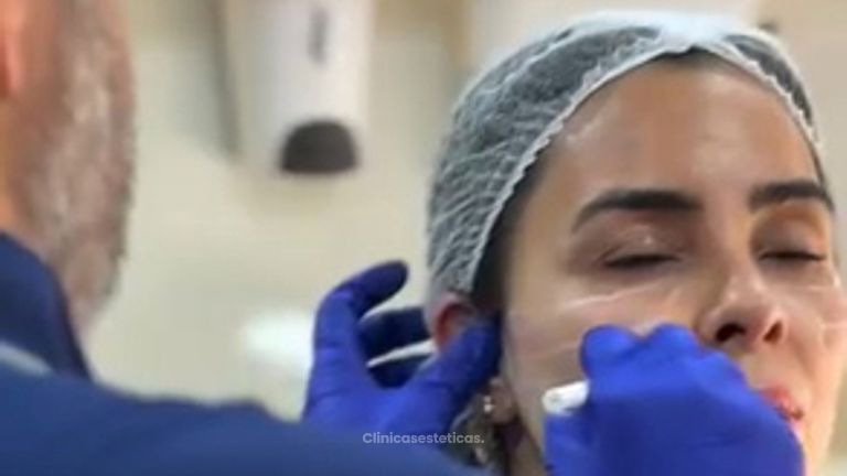 Rejuvenecimiento Facial - Dr. Marcelo Fonseca Canteros