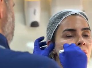 Rejuvenecimiento Facial - Dr. Marcelo Fonseca Canteros