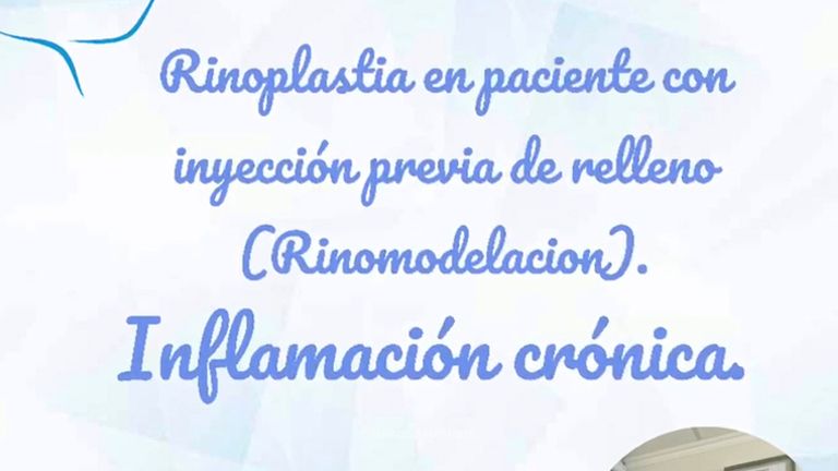 Rinoplastia - Dr. Rodrigo Pinto Carcamo
