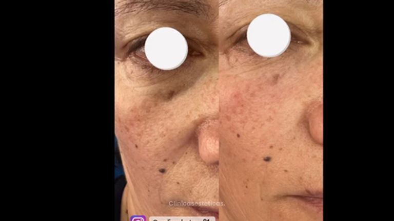 relleno de ojeras y surcos nasogeniano con ácido Hialuronico