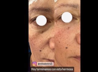 relleno de ojeras y surcos nasogeniano con ácido Hialuronico