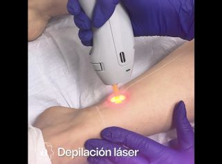 Depilación láser - Amanda Beauty