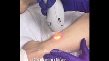 Depilación láser - Amanda Beauty