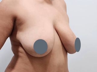 Mastopexia - Dr. Nadir Carda