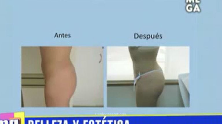 Abdominoplastia