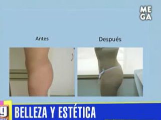 Abdominoplastia