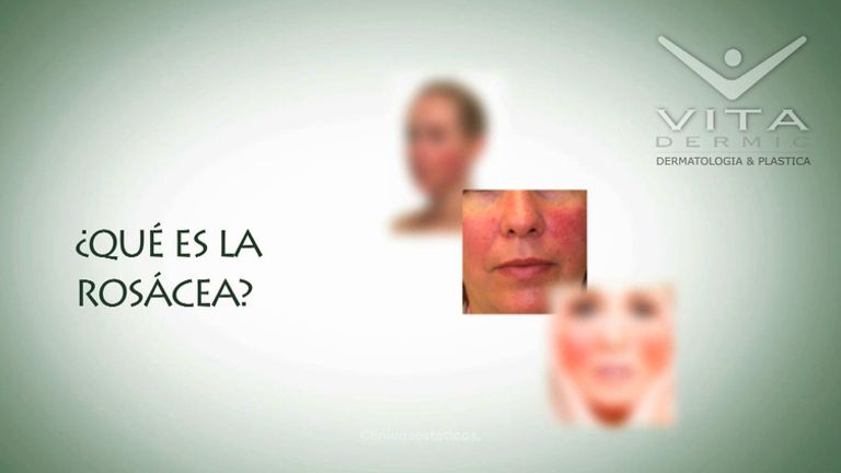 ¿Qué es la rosácea?
