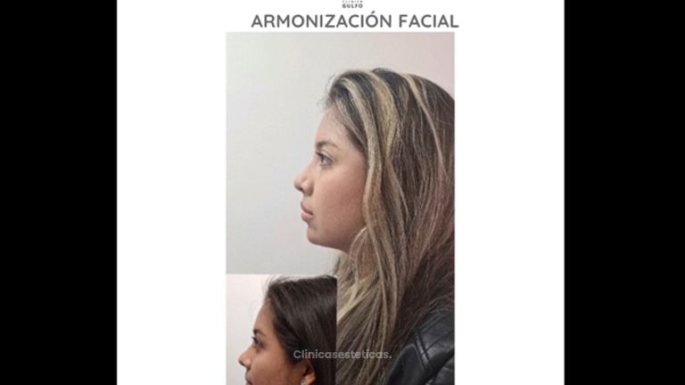 Armonización facial - Dra. Kelly Gulfo