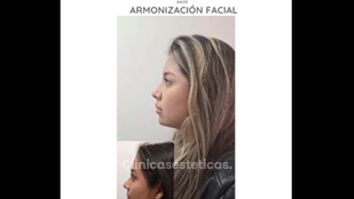 Armonización facial - Dra. Kelly Gulfo