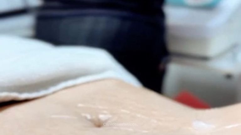 Eliminación de grasa tratamiento combinado - Amarna