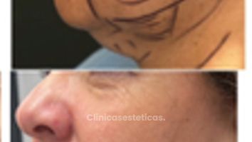 Rejuvenecimiento facial - Clínica Oviedo