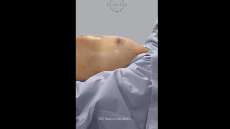 Aumento mamario - Dr. Nadir Carda