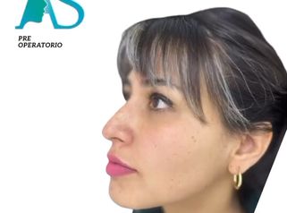 Rinoplastia - Dra. Angélica Sifontes Muñoz