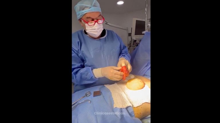 Recambio de implantes - Dr. René Flores Aqueveque