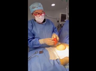 Recambio de implantes - Dr. René Flores Aqueveque