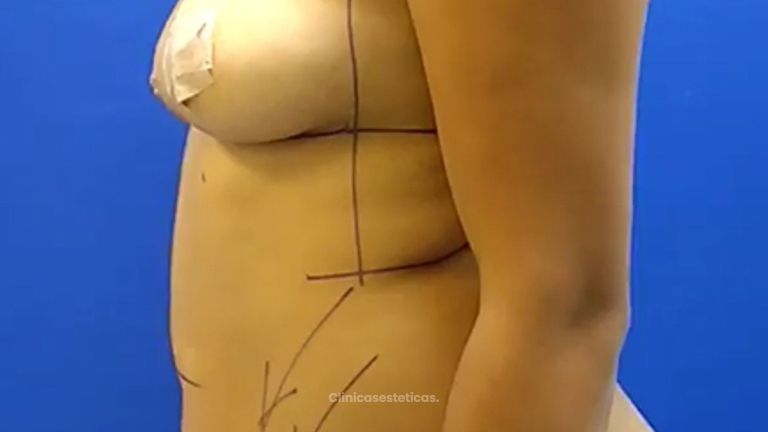 Lipoabdominoplastia