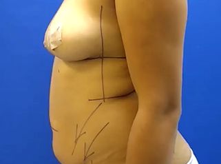 Lipoabdominoplastia