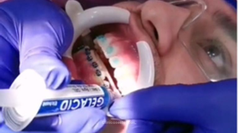 Instalación de ortodoncia paso a paso. 