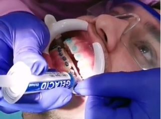 Instalación de ortodoncia paso a paso. 