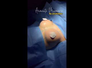 Aumento mamario - Dr. Alvaro Rubio González