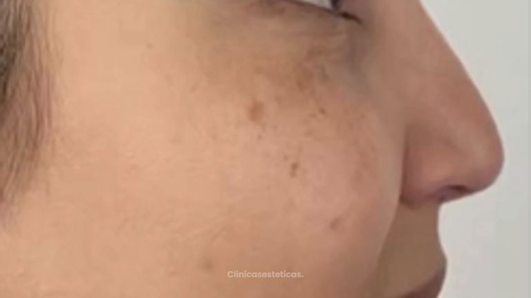 Rinomodelación  - Clínica Visage