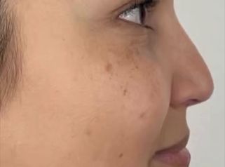 Rinomodelación  - Clínica Visage