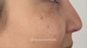 Rinomodelación  - Clínica Visage