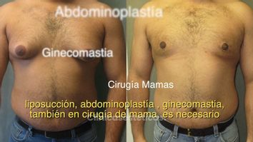 Rol de la Kinesiología en Cirugía Plástica