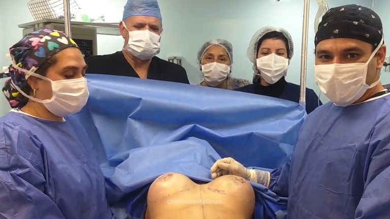 Lipoescultura + abdominoplastia + implante mamario y pexia