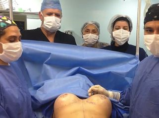 Lipoescultura + abdominoplastia + implante mamario y pexia