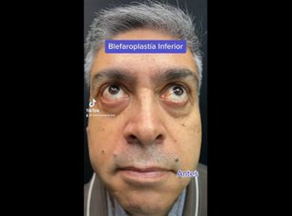 Blefaroplastia - Medicina Estética Integral MD