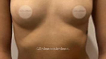 Aumento Mamario - Dr. Guillermo Santana