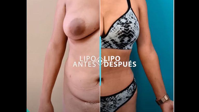 Resultados: Lipoabdominoplastia + Transferencia Glútea