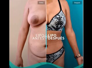 Resultados: Lipoabdominoplastia + Transferencia Glútea