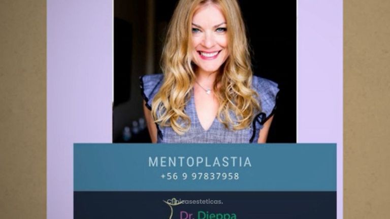 Rinoplastia + Mentoplastia - Cirugía Plástica Dieppa