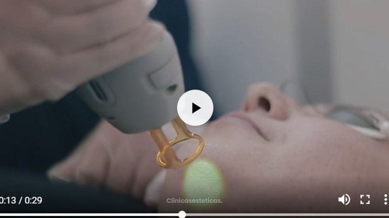 Depilación Laser