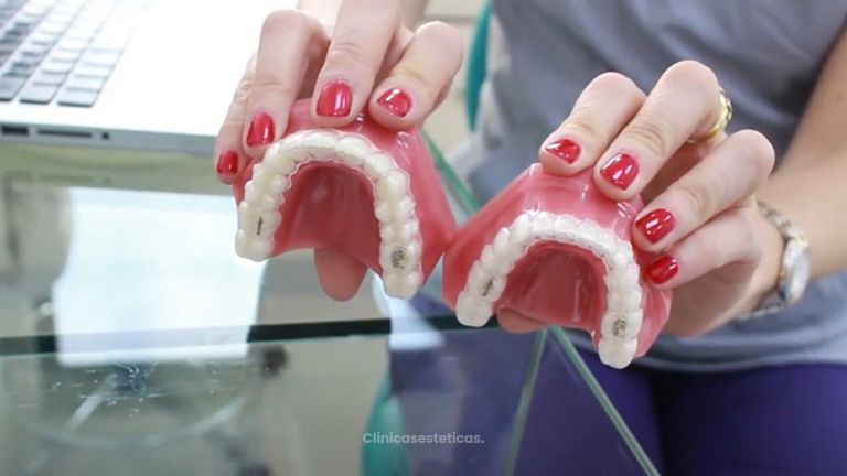 Alineadores Dentales - Clinica Ortodontik