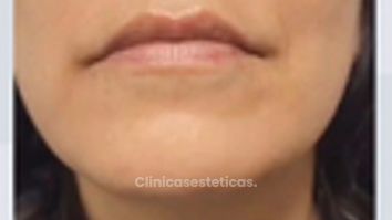 Aumento de Labios con Ácido Hialurónico - Dr. Nadir Carda