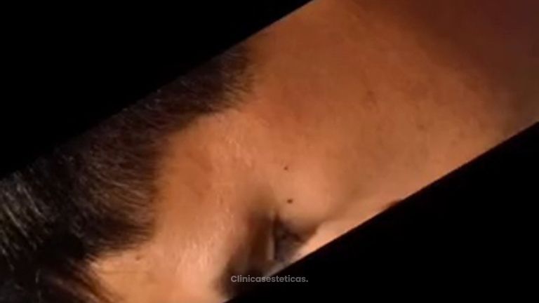 Rinoplastia Ultrasonica - Dra. Angélica Sifontes Muñoz