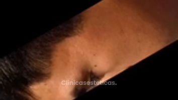 Rinoplastia Ultrasonica - Dra. Angélica Sifontes Muñoz