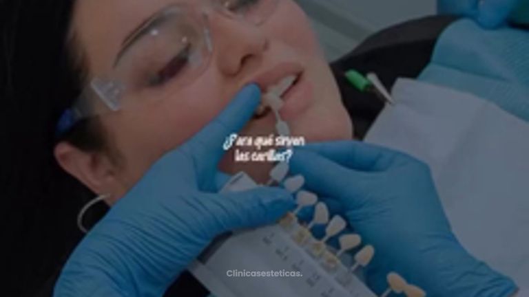 Carillas Dentales - Clinica Visage