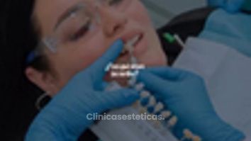 Carillas Dentales - Clinica Visage