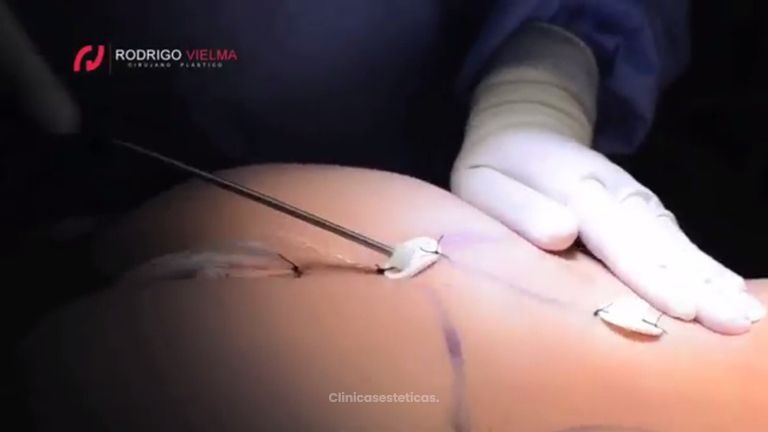 Elimina la grasa sobrante de tu cuerpo