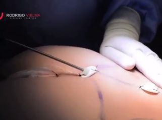 Elimina la grasa sobrante de tu cuerpo