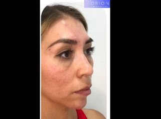 Rejuvenecimiento facial - Clínica Orión