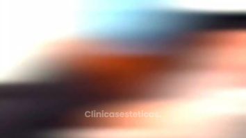 Blefaroplastia - Dr. Sebástian Cosentino