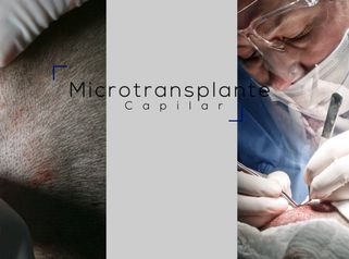 Microtransplante capilar - Clínica Santiago Estética