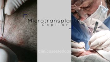 Microtransplante capilar - Clínica Santiago Estética