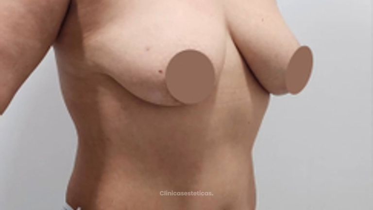 Mastopexia - Dr. Nadir Carda