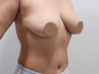Mastopexia - Dr. Nadir Carda